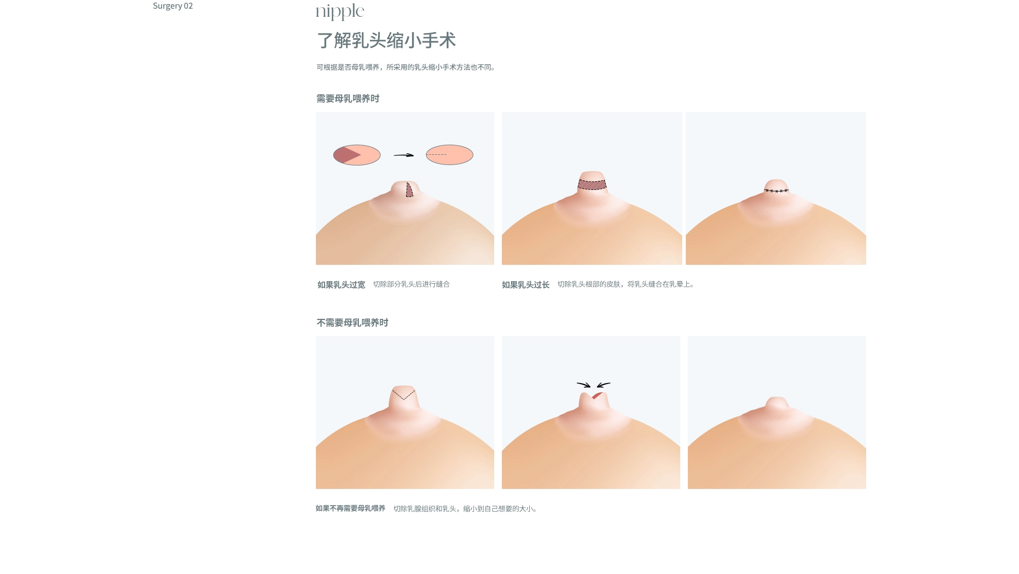 乳晕/乳头矫正