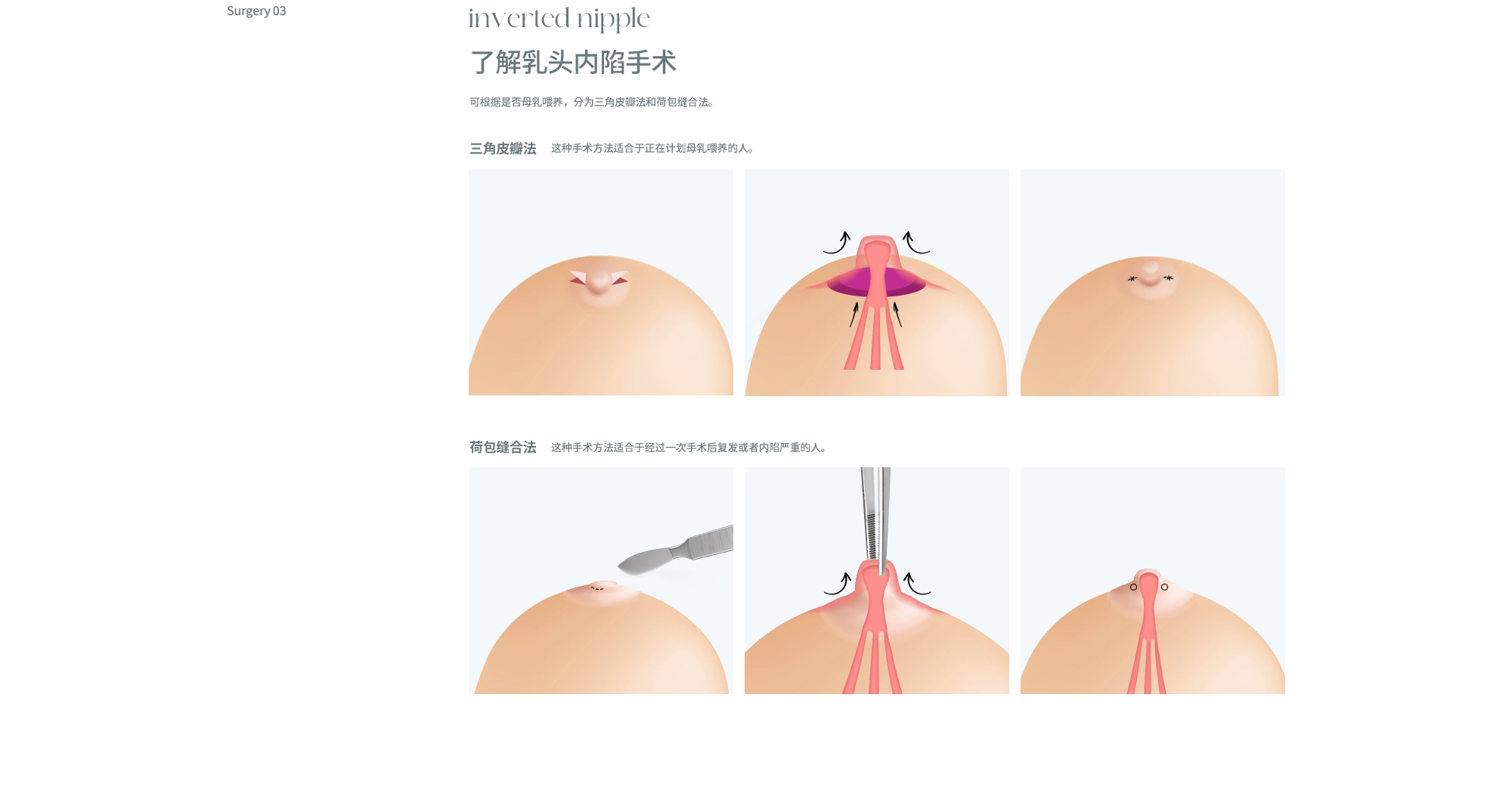 乳晕/乳头矫正